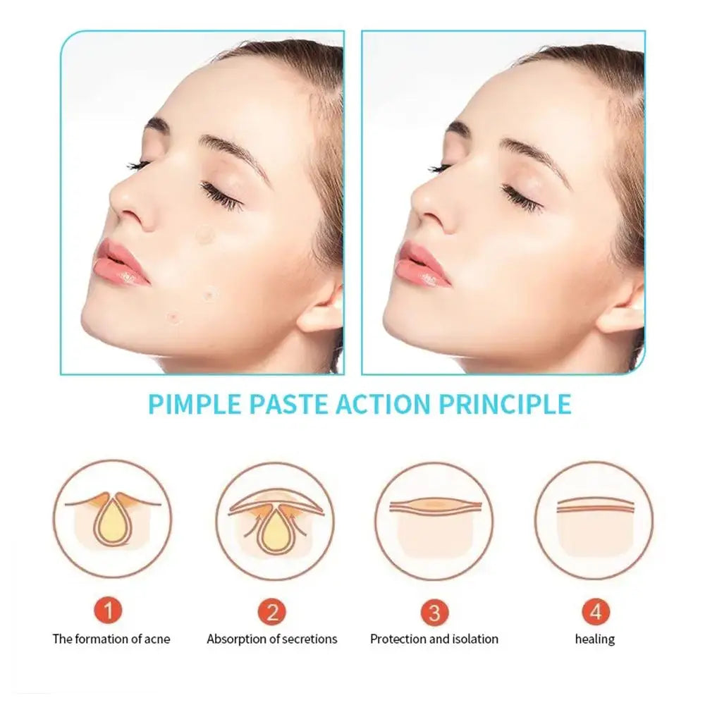 30pcs Acne Pimple Patches Invisible Removal Pimple Anti-Acne Hydrocolloid Patches Spots Mark Concealer Waterproof Repair Sticker